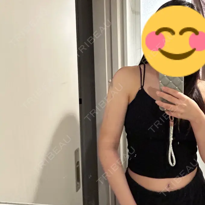 脂肪吸引（顔） / 脂肪吸引（二の腕） / ジョールファット除去 / 脂肪吸引（肩） 湘南美容クリニック Regno 銀座院 DAY 3 メイン用