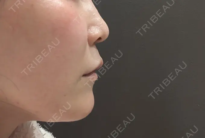 シワ取りボトックス / ボトックス（眉間） / ボトックス（額） / ハイフ（顔） / 美肌レーザー / シミ取りレーザー / 美白レーザー / ピコレーザートーニング（美白・肝斑） / レーザートーニング（美白・肝斑） LE CLINIC AFTER メイン用