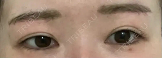 眉下切開 / ボトックス（眉間） / ボトックス（額） 銀座リシェスクリニック AFTER メイン用