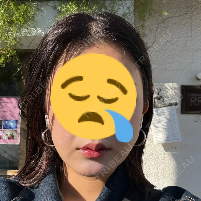 糸リフト / 脂肪吸引（顔） 下北沢スキンクリニック DAY 18 メイン用