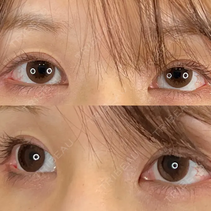 クマ治療 / 下まぶたの脂肪取り / 脂肪注入（目の下） / ボトックス（額） 藤・ナチュレ美容クリニック 銀座院 DAY 10 メイン用