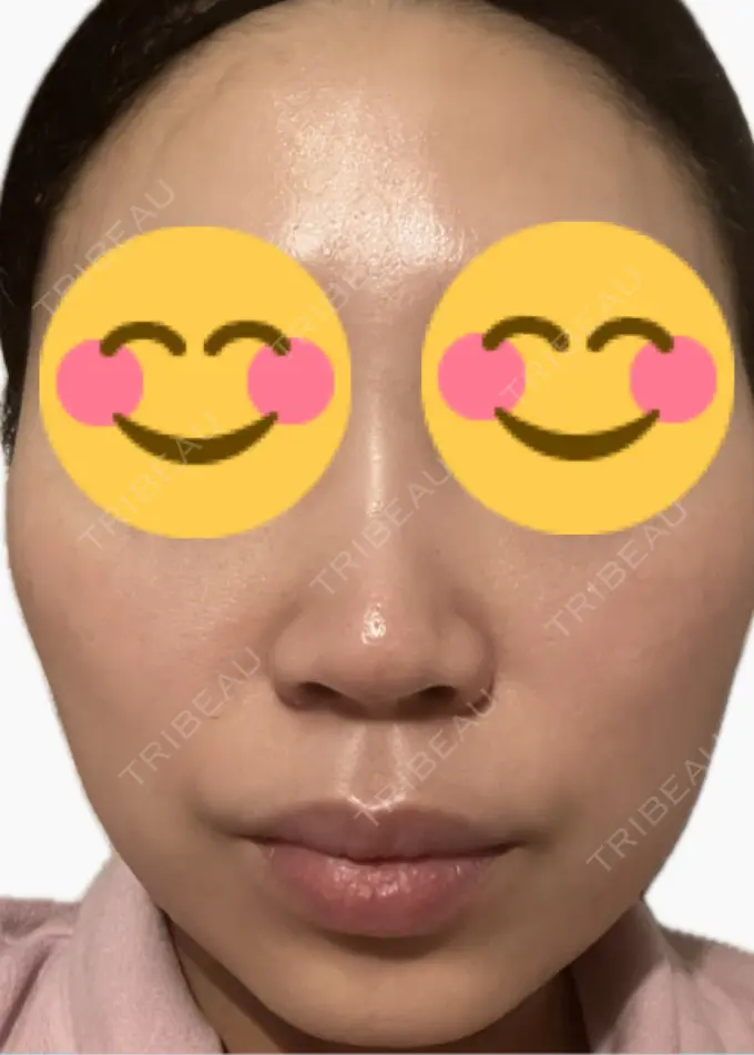 プラセンタ注射 美容皮膚科エルムクリニック 麻布院 DAY 3 メイン用