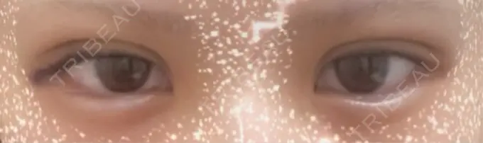 二重埋没 恵聖会クリニック 心斎橋院 AFTER メイン用