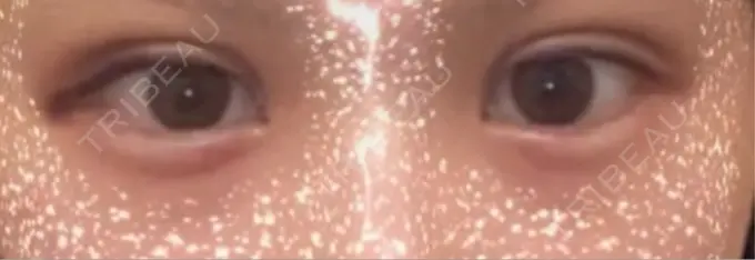 二重埋没 恵聖会クリニック 心斎橋院 DAY 1 メイン用