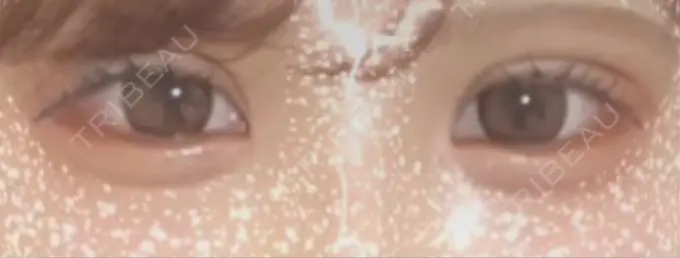 二重埋没 恵聖会クリニック 心斎橋院 DAY 1 メイン用