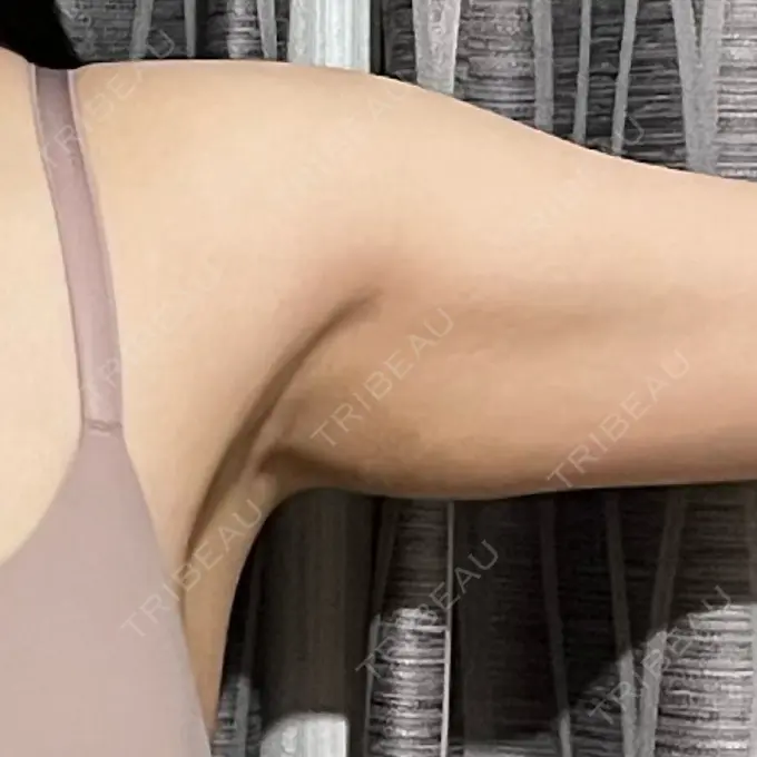 ワキ汗治療（レーザー） Fellez Clinic【フェルズクリニック】 AFTER メイン用