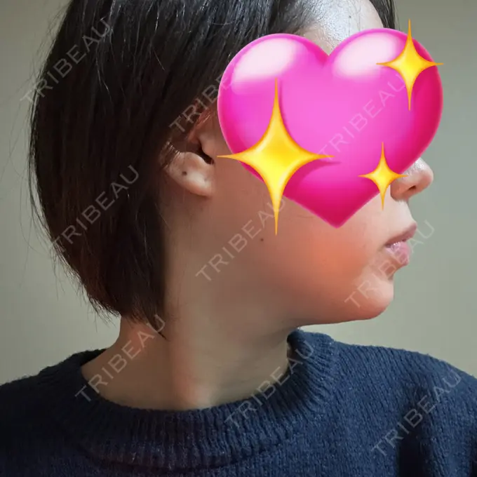 ヒアルロン酸注入（あご） Otus Clinic 【オータスクリニック】 DAY 1 メイン用