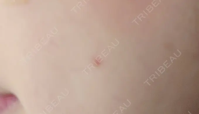 ほくろ・いぼ切除（肌） 札幌中央クリニック DAY 3 メイン用