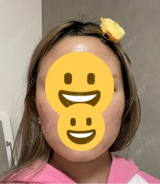 ボトックス（エラ・小顔） 共立美容外科 神戸三宮院 DAY 26 メイン用