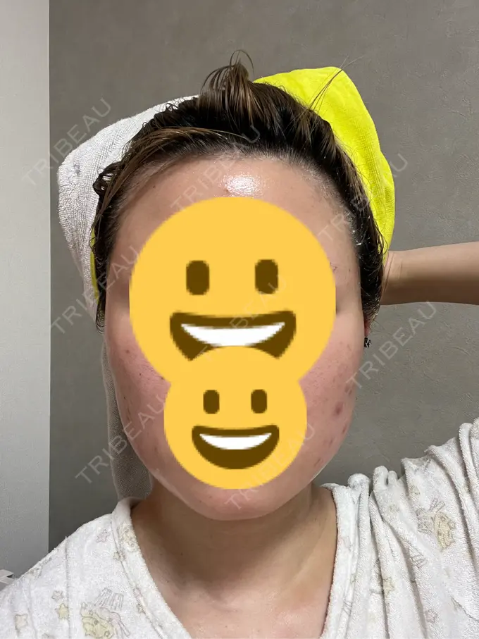 ボトックス（エラ・小顔） 共立美容外科 神戸三宮院 DAY 9 メイン用