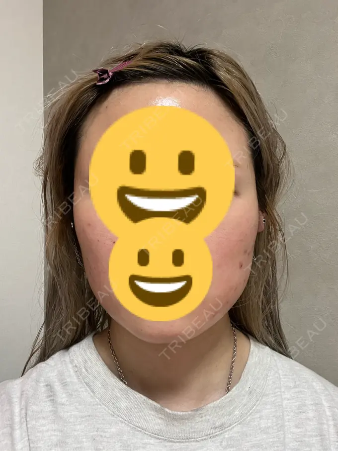 ボトックス（エラ・小顔） 共立美容外科 神戸三宮院 DAY 17 メイン用