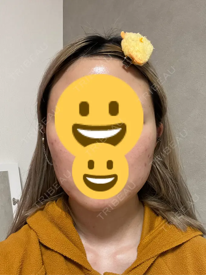 ボトックス（エラ・小顔） 共立美容外科 神戸三宮院 DAY 30 メイン用