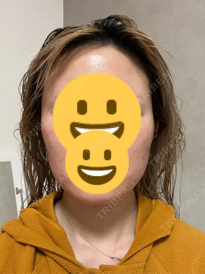 ボトックス（エラ・小顔） 共立美容外科 神戸三宮院 DAY 35 メイン用