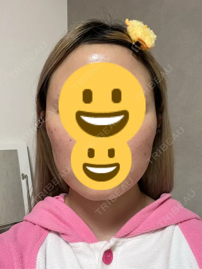 ボトックス（エラ・小顔） 共立美容外科 神戸三宮院 DAY 40 メイン用