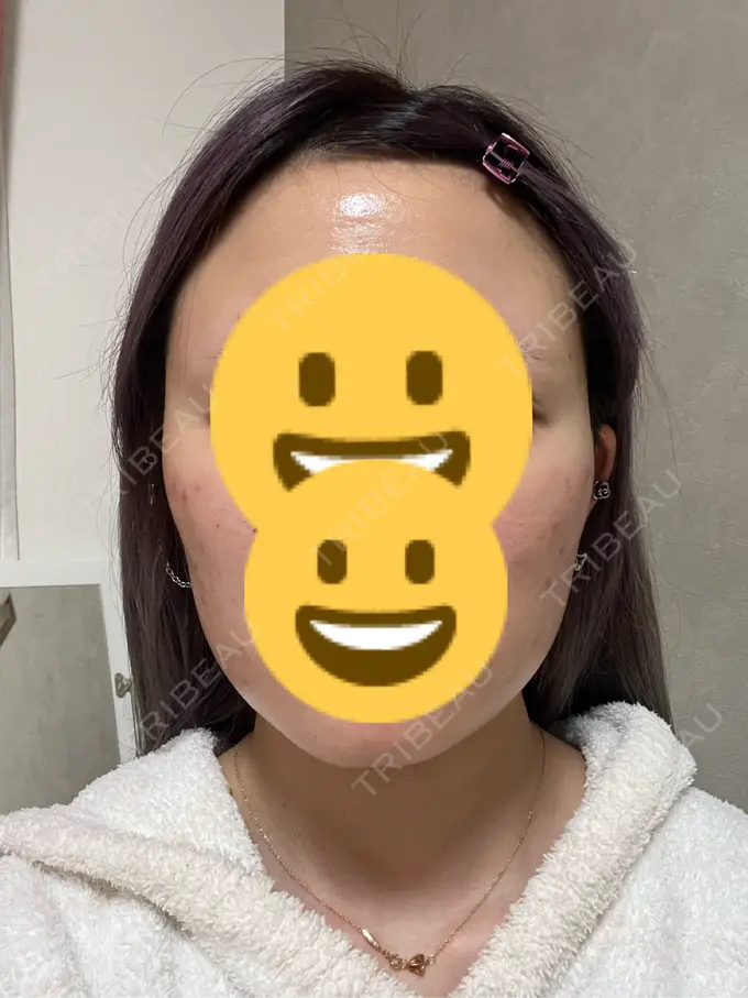 ボトックス（エラ・小顔） 共立美容外科 神戸三宮院 DAY 52 メイン用