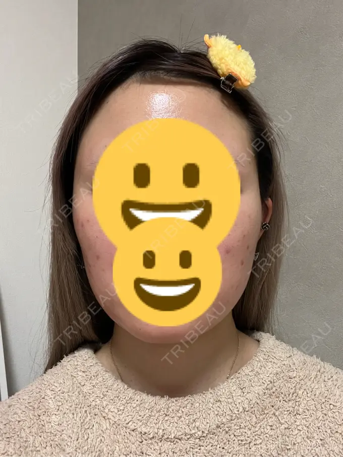 ボトックス（エラ・小顔） 共立美容外科 神戸三宮院 DAY 63 メイン用