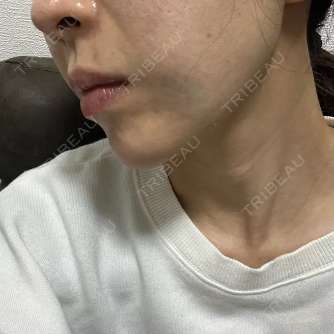 糸リフト / 脂肪吸引（顔） / 脂肪吸引注射（顔） ziz CLINIC DAY 0 メイン用