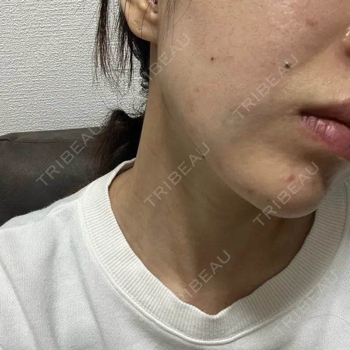 糸リフト / 脂肪吸引（顔） / 脂肪吸引注射（顔） ziz CLINIC DAY 0 メイン用