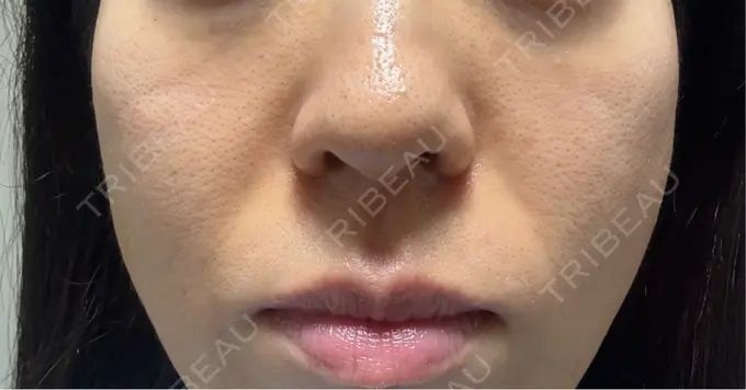 ジャルプロ 城本クリニック 静岡院 DAY 14 メイン用