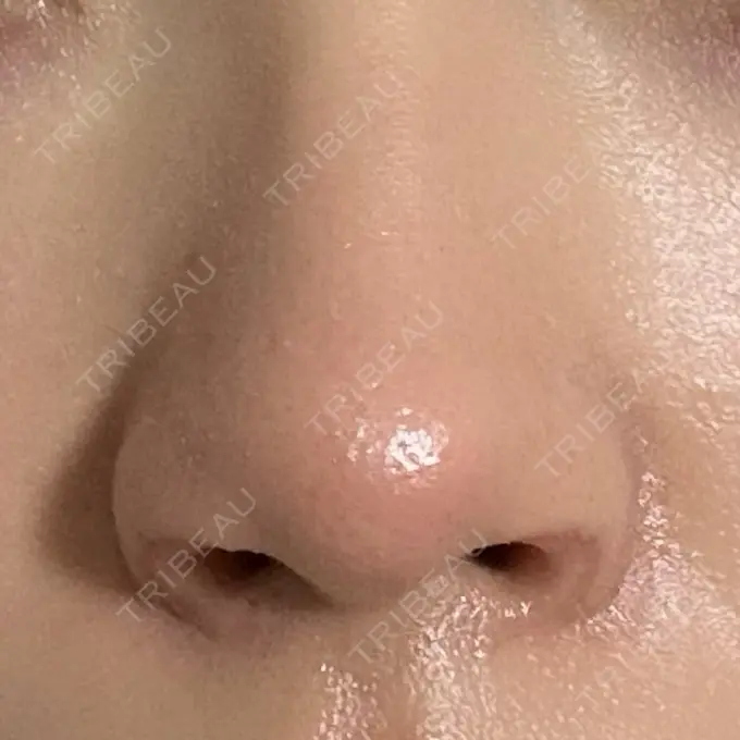 鼻孔縁挙上 シエルクリニック DAY 16 メイン用