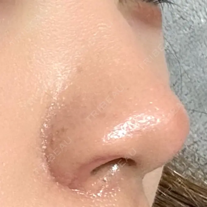 鼻孔縁挙上 シエルクリニック DAY 16 メイン用