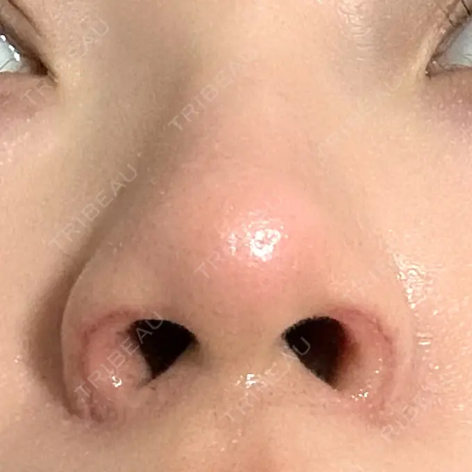 鼻孔縁挙上 シエルクリニック DAY 16 メイン用