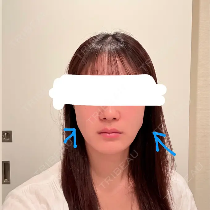 ボトックス（エラ・小顔） / その他（輪郭） 大美会クリニック 心斎橋本院 AFTER メイン用