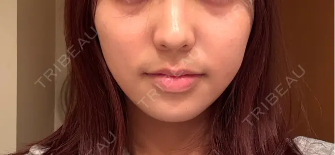 糸リフト / バッカルファット除去 / 脂肪吸引注射（顔） First Clinic AFTER メイン用