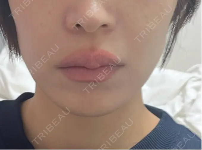 ボトックス（エラ・小顔） TCB東京中央美容外科 新宿東口院 AFTER メイン用