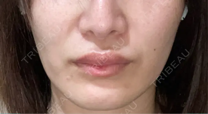 ヒアルロン酸注入（涙袋） / ヒアルロン酸注入（唇） 博多美容外科/美容皮膚科 ビラビューティークリニック DAY 1 メイン用