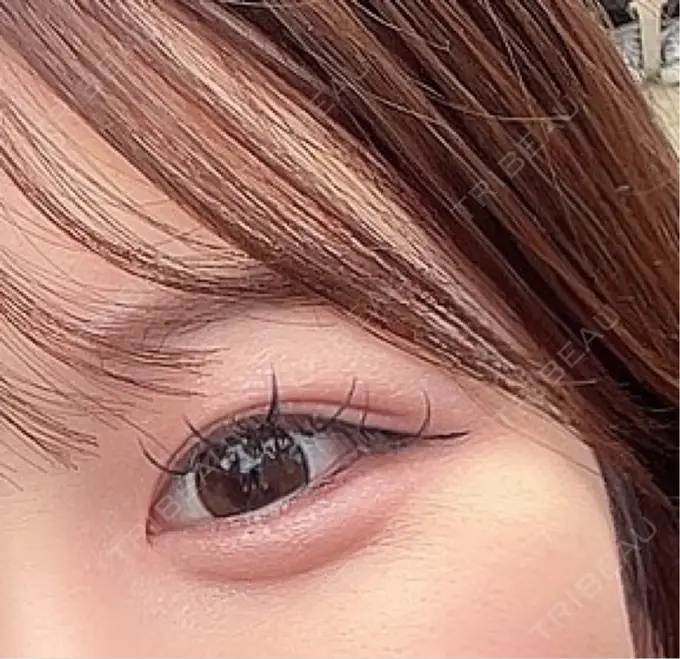 ヒアルロン酸注入（涙袋） / ボトックス（タレ目） アネシス美容クリニック DAY 30 メイン用