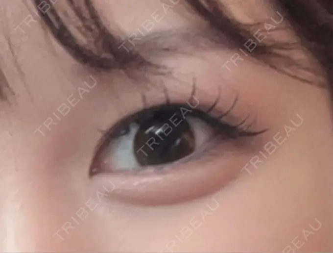 ヒアルロン酸注入（涙袋） / ボトックス（タレ目） アネシス美容クリニック DAY 21 メイン用