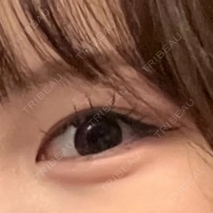 ヒアルロン酸注入（涙袋） / ボトックス（タレ目） アネシス美容クリニック DAY 27 メイン用