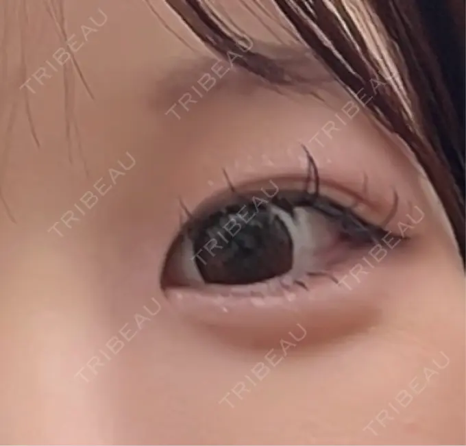 ヒアルロン酸注入（涙袋） / ボトックス（タレ目） アネシス美容クリニック DAY 151 メイン用