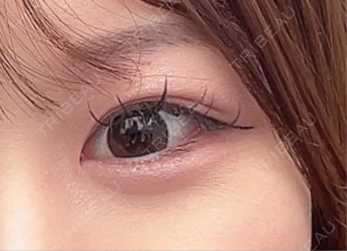 ヒアルロン酸注入（涙袋） / ボトックス（タレ目） アネシス美容クリニック DAY 212 メイン用