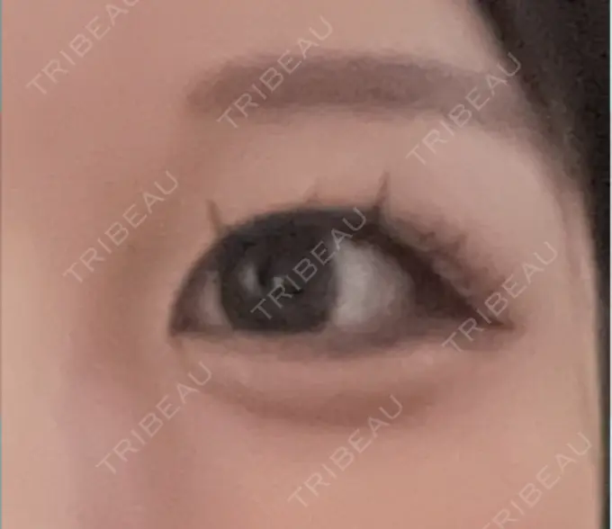 ヒアルロン酸注入（涙袋） / ボトックス（タレ目） アネシス美容クリニック DAY 229 メイン用