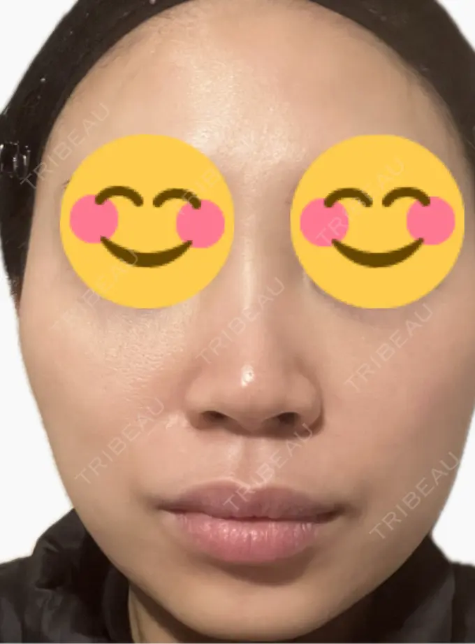 プラセンタ注射 美容皮膚科エルムクリニック 麻布院 DAY 4 メイン用