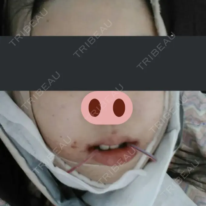 骨切り（あご） / 骨削り（エラ） / 骨削り（頬） / 脂肪吸引（顔） View美容整形外科 AFTER メイン用