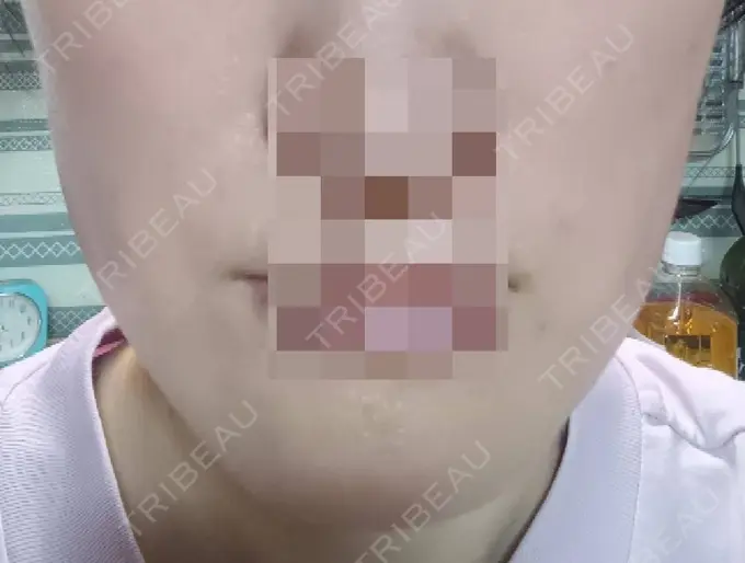 ボトックス（エラ・小顔） 高崎TAクリニック DAY 2 メイン用