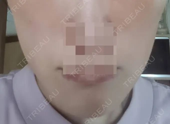 ボトックス（エラ・小顔） 高崎TAクリニック DAY 7 メイン用