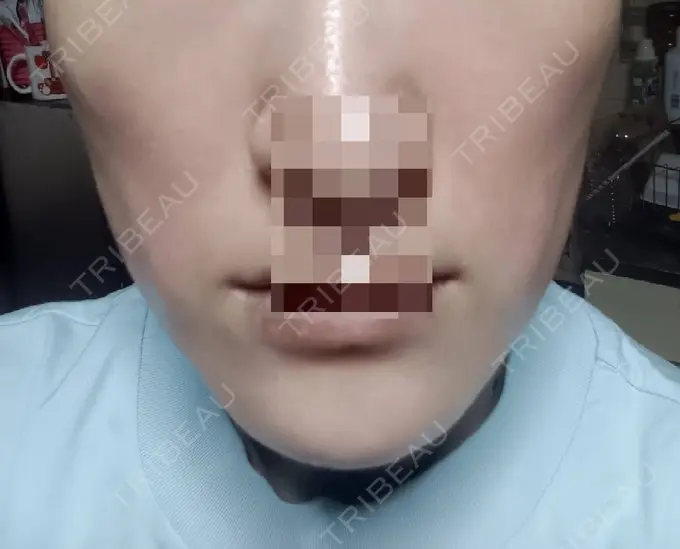 ボトックス（エラ・小顔） 高崎TAクリニック DAY 21 メイン用