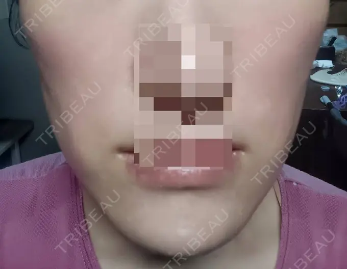 ボトックス（エラ・小顔） 高崎TAクリニック DAY 28 メイン用