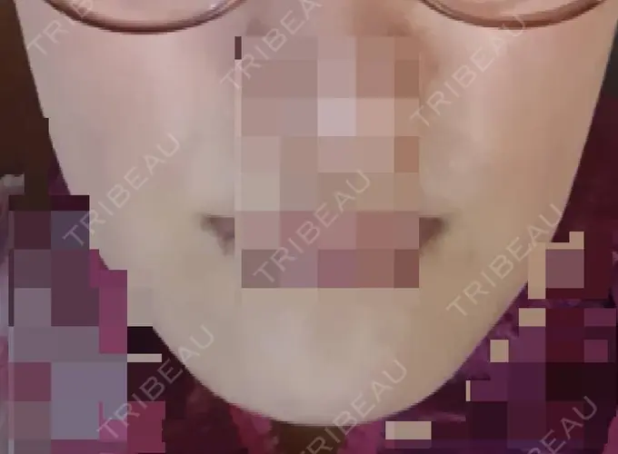 ボトックス（エラ・小顔） 高崎TAクリニック DAY 35 メイン用