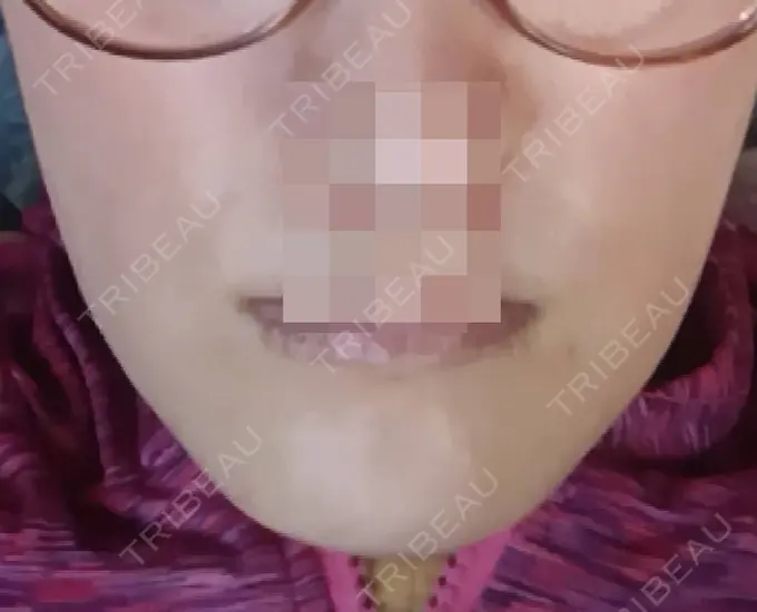 ボトックス（エラ・小顔） 高崎TAクリニック AFTER メイン用