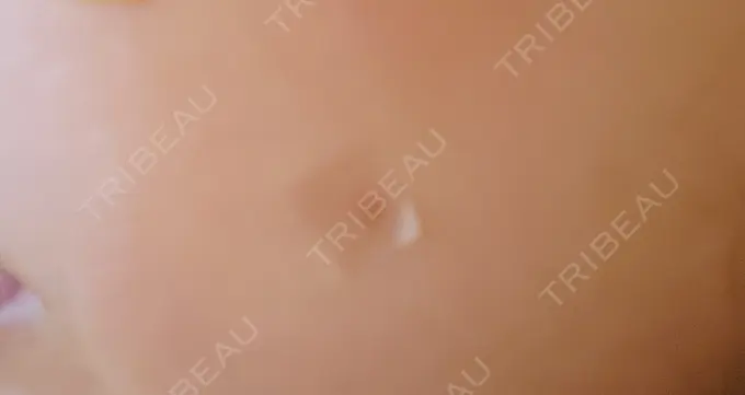 ほくろ・いぼ切除（肌） 札幌中央クリニック DAY 9 メイン用