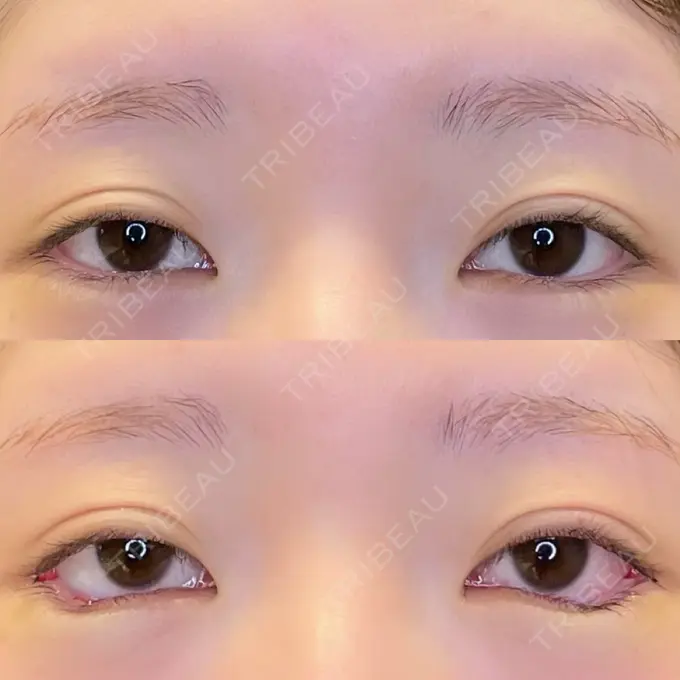 目尻切開 / タレ目形成・グラマラスライン（埋没） / ボトックス（タレ目） LOUIS CLINIC 二子玉川院【ルイクリニック】 DAY 0 メイン用