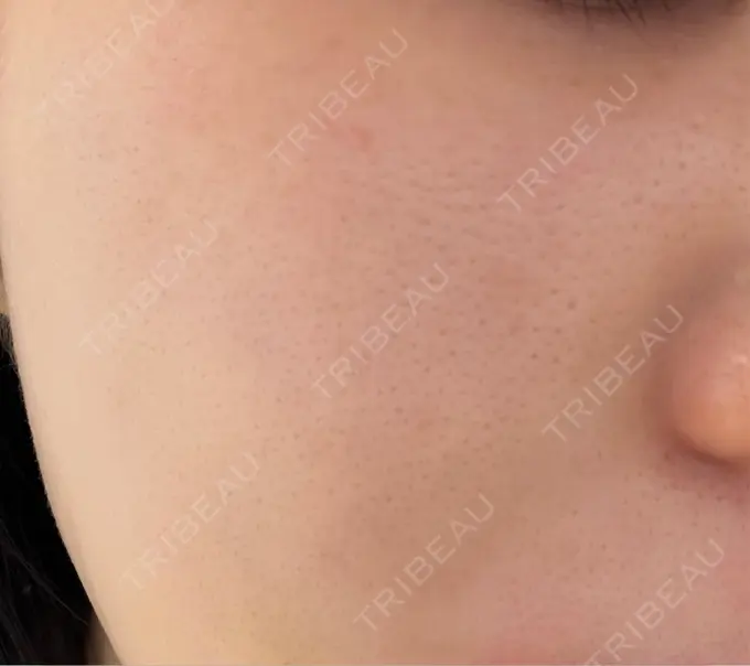 レーザーフェイシャル 矢場町ひふ形成外科クリニック DAY 0 メイン用