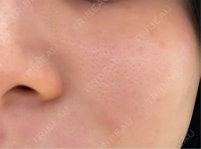 レーザーフェイシャル 矢場町ひふ形成外科クリニック DAY 0 メイン用