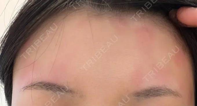 レーザーフェイシャル 矢場町ひふ形成外科クリニック DAY 0 メイン用