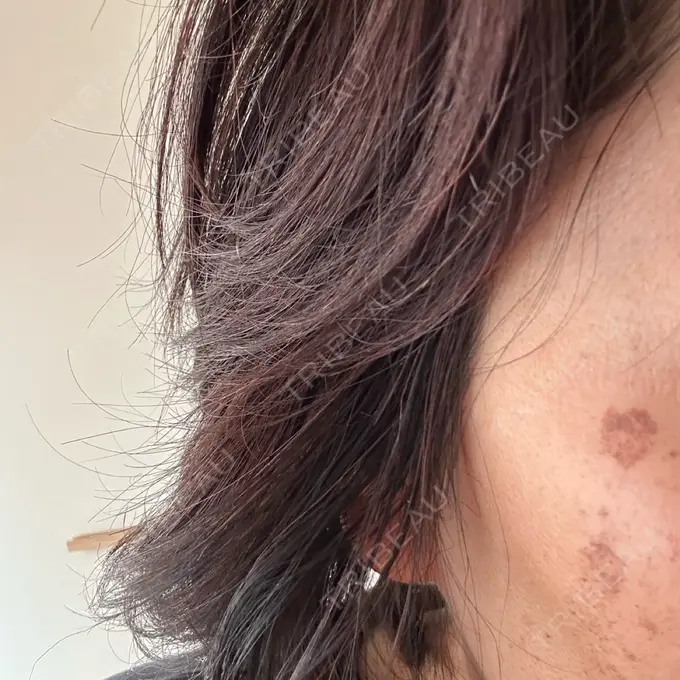 ルメッカ 東京美容外科 名古屋院 AFTER メイン用